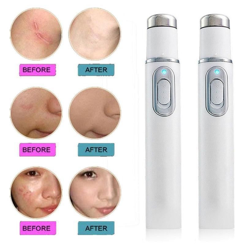 Blue light spot treatment pen by Glow Ritual
